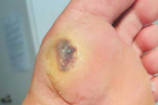 Fusssohle: gelbliche Hyperkeratose mit dunkler Einblutung unter einem Mittelfussknochenköpfchen bei Diabetes.