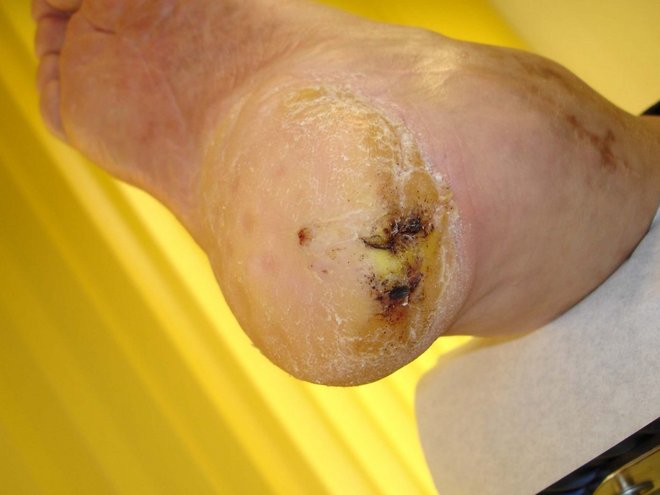 Ferse von unten: flächige Hyperkeratose mit schwarz belegter, nekrotischer Wunde am Fersenrand bei Diabetes mellitus.