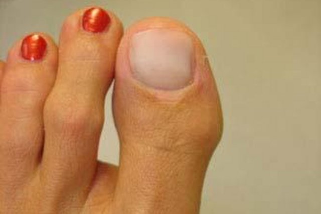 Grosszehe mit modellierter Nagelprothese; die übrigen Nägel sind lackiert