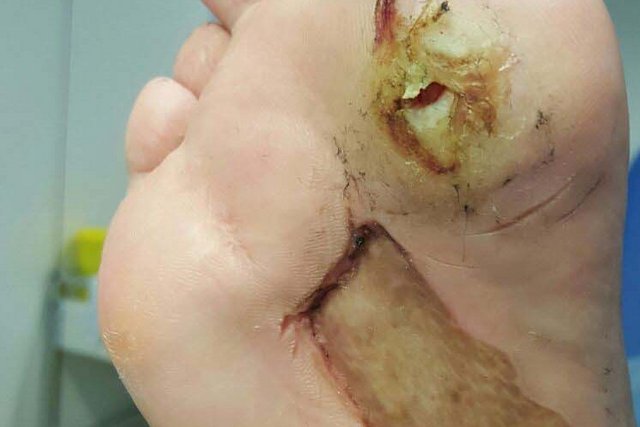 Fusssohle im Vorfussbereich: Hyperkeratose mit offener Wunde am Ballen, darunter das verheilte Spalthauttransplantat bei Diabetes mellitus.